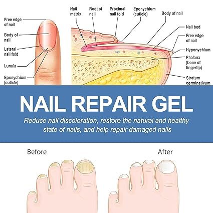 REGENERADOR PRO - TRATAMIENTO PARA LOS HONGOS DE LAS UÑAS EN GEL