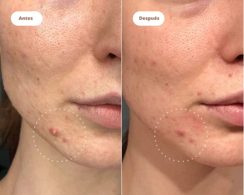 ACNE PATH - Parche para Espinillas e Imperfecciones