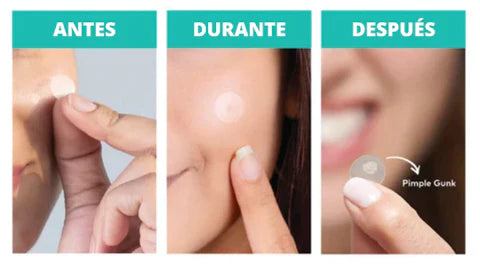 ACNE PATH - Parche para Espinillas e Imperfecciones