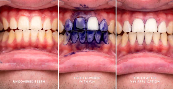 HISMILE - BLANQUEADOR DENTAL PRO