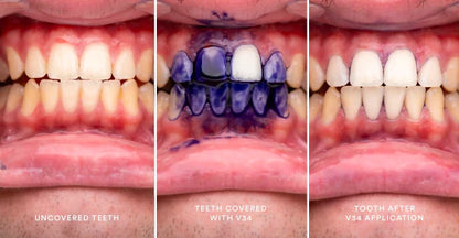 HISMILE - BLANQUEADOR DENTAL PRO